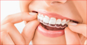 Is Invisalign Covered Under Dental Protection?
